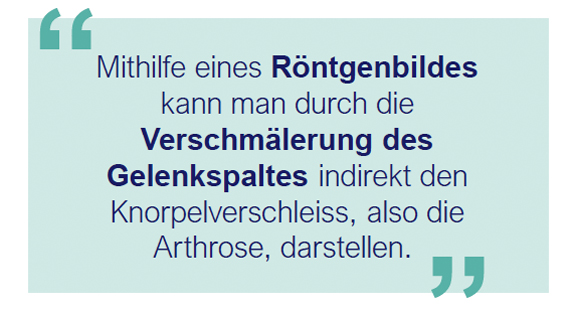 Articon.ch Arthrose des Hüftgelenkes (Coxarthrose)