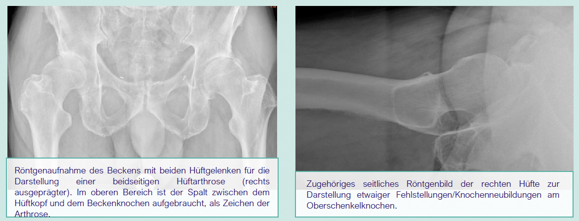 Articon.ch Arthrose des Hüftgelenkes (Coxarthrose)