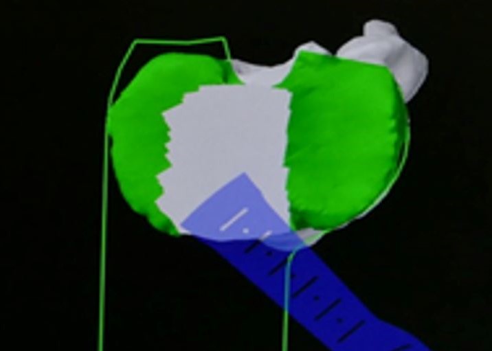 Echtzeit-Animation mit dem Sägeblatt (blau). Die grünen Linien zeigen den engen Bereich, in welchem sich die Säge überhaupt aktivieren lässt. Die grün markierte Knochenfläche wird entfernt.