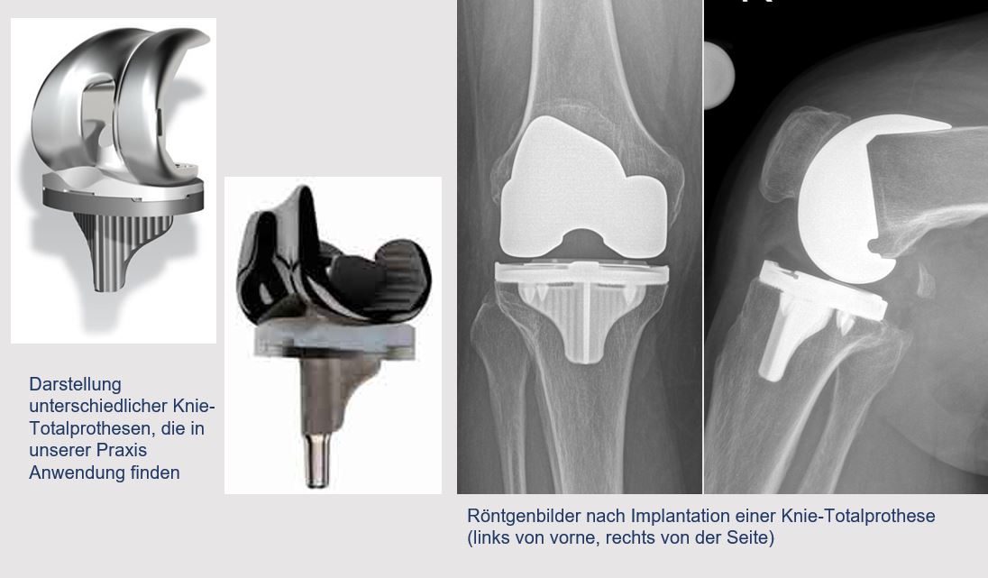 Die Knie-Prothese 