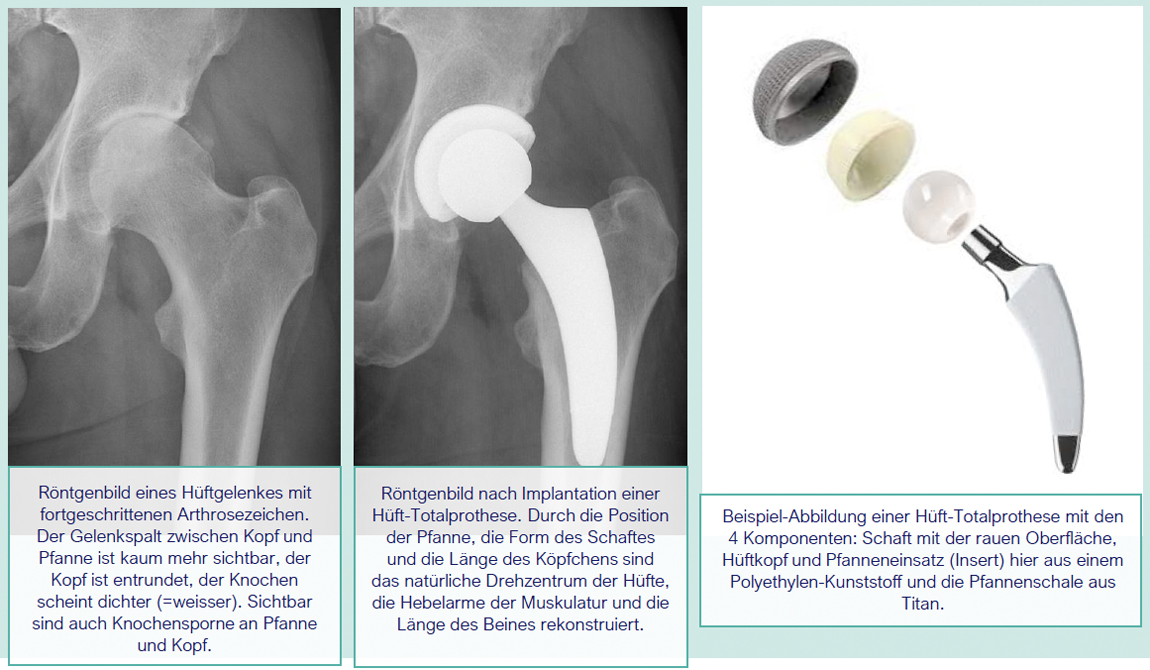 Articon.ch Prinzip der Hüft-Totalprothese